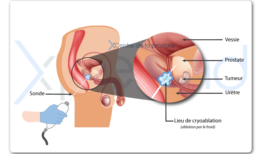 Le cancer de la prostate: quel traitement ? - XperMD Paris