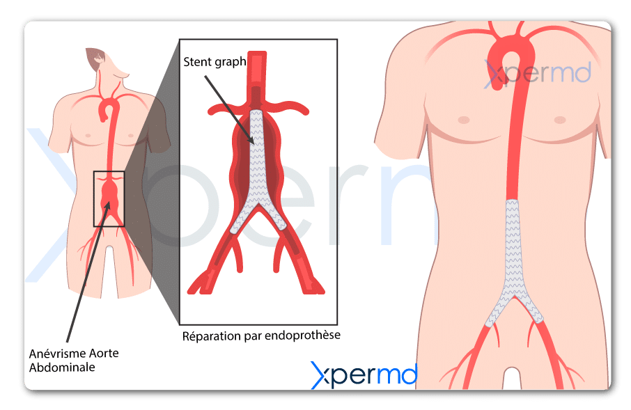 anévrisme aorte traitement par endoprothèse