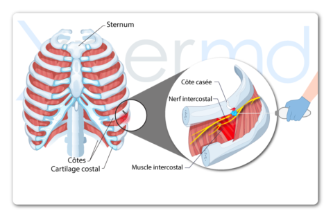 Côte cassée ? Un traitement peu invasif - XperMD