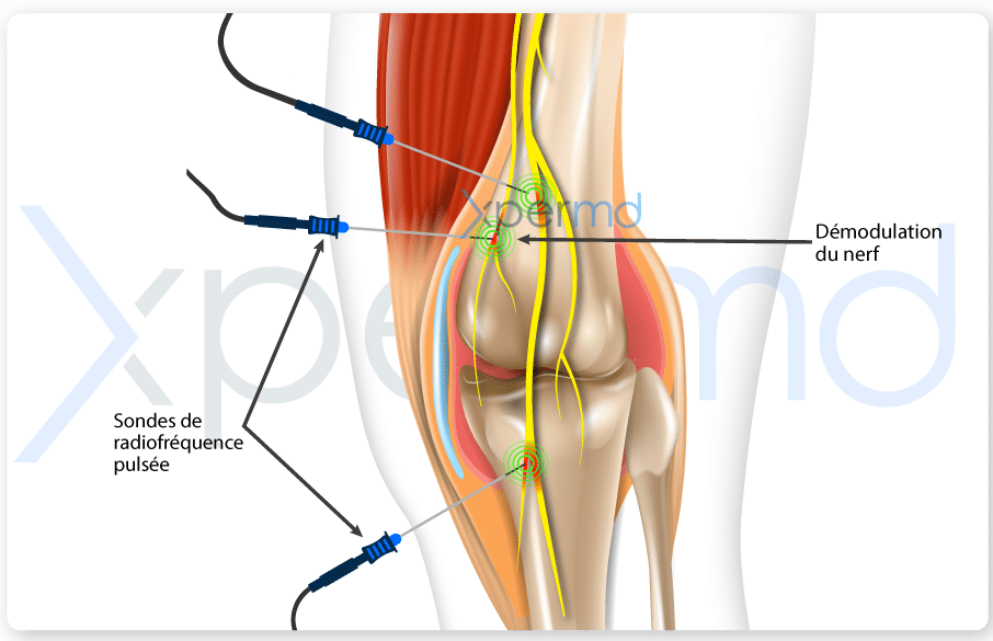 radiofréquence pulsée pour les douleurs du genou