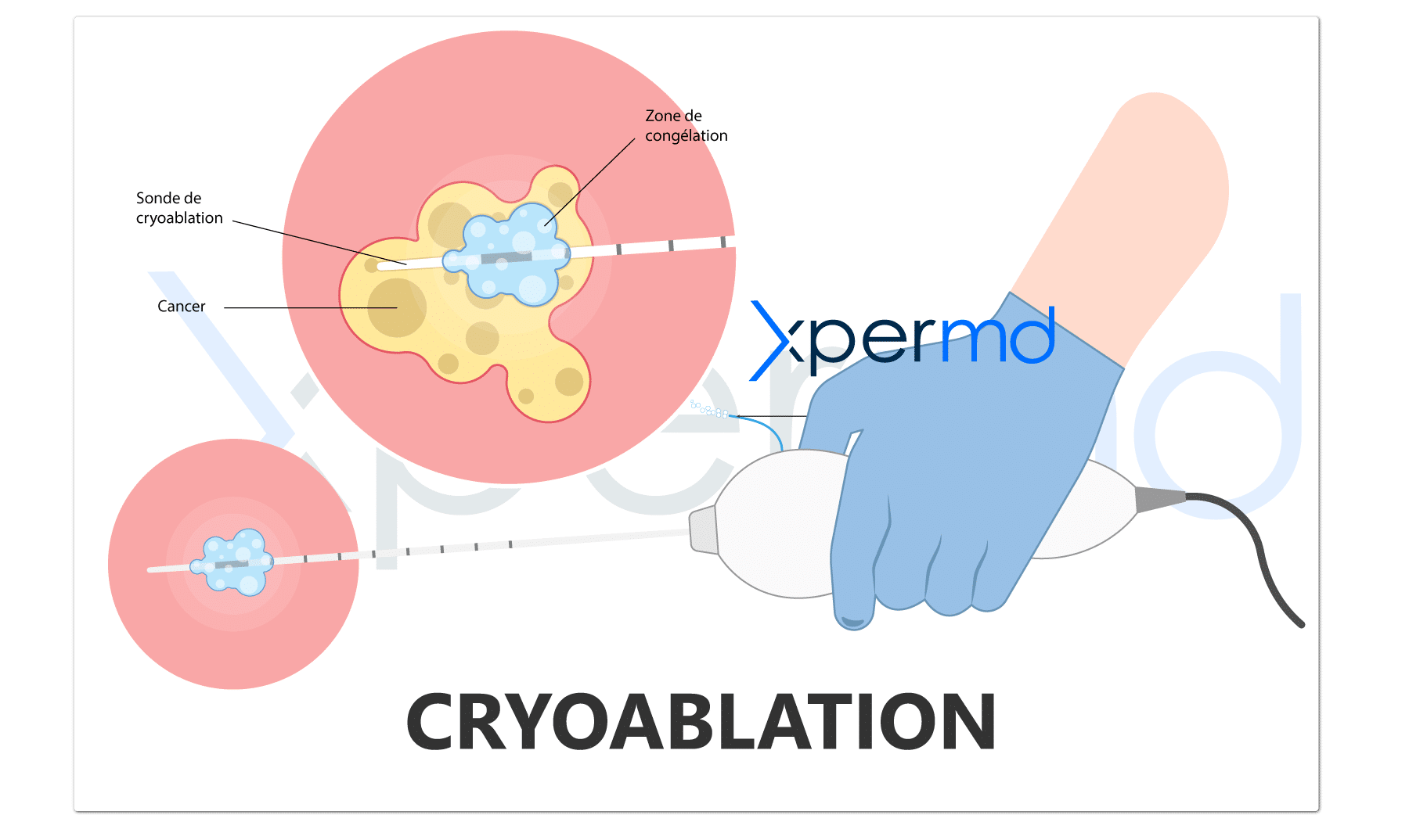 cancer du rein cryoablation